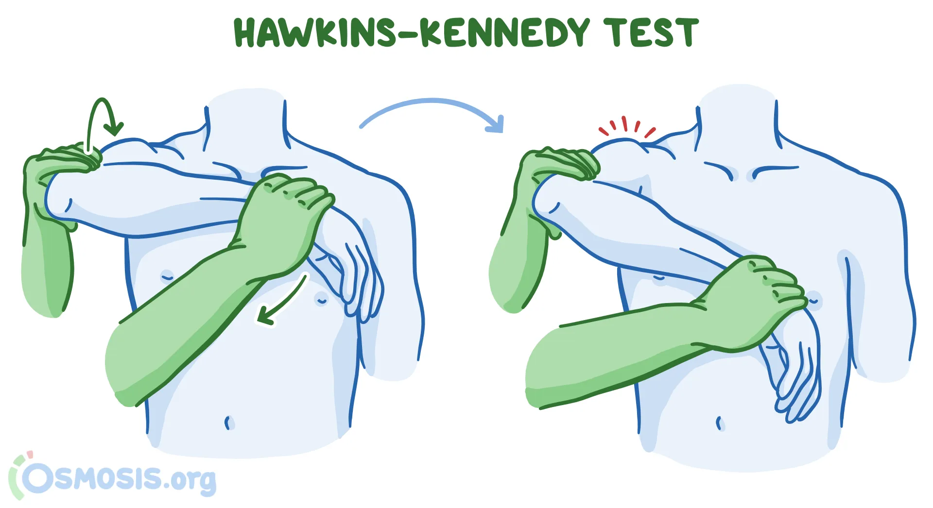hawkins-kennedy-test.png